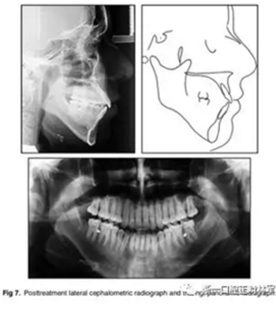 文獻優(yōu)秀正畸病例賞析-通過微種植釘及多曲方絲技術壓低下頜磨牙非手術矯治嚴重前牙開合患者1例