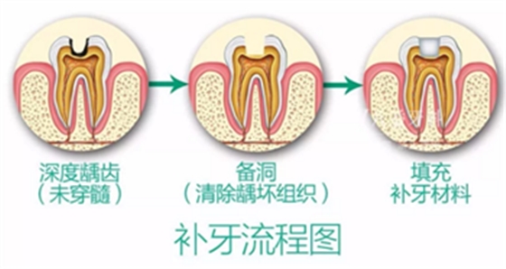 完全不懂，各種補(bǔ)牙材料，到底怎么選？