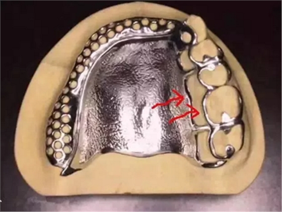 活動義齒修復，要懂的鋼托設計