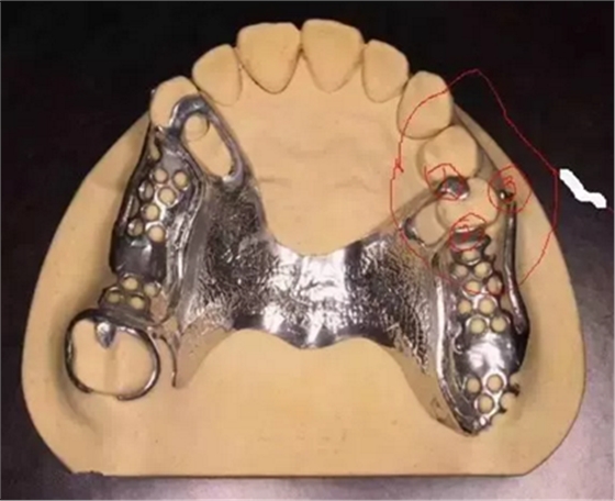 活動義齒修復，要懂的鋼托設計