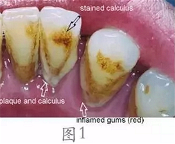 	 牙齦碰不得，一碰就出血。這是咋回事？