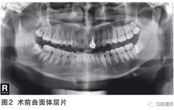 前牙即刻種植并個性化基臺美學(xué)修復(fù)