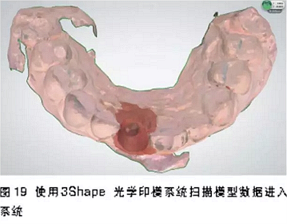 前牙即刻種植并個性化基臺美學(xué)修復(fù)