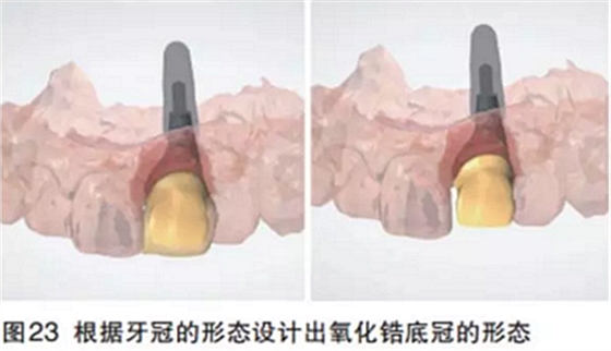 前牙即刻種植并個性化基臺美學(xué)修復(fù)