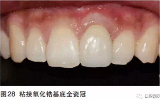 前牙即刻種植并個性化基臺美學(xué)修復(fù)