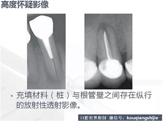 牙根縱裂