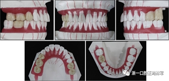文獻優(yōu)秀正畸病例賞析--多顆牙齒缺失的牙周炎患者的跨學(xué)科綜合治療