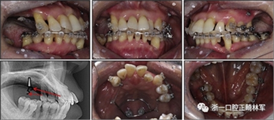 文獻優(yōu)秀正畸病例賞析--多顆牙齒缺失的牙周炎患者的跨學(xué)科綜合治療