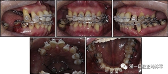 文獻優(yōu)秀正畸病例賞析--多顆牙齒缺失的牙周炎患者的跨學(xué)科綜合治療