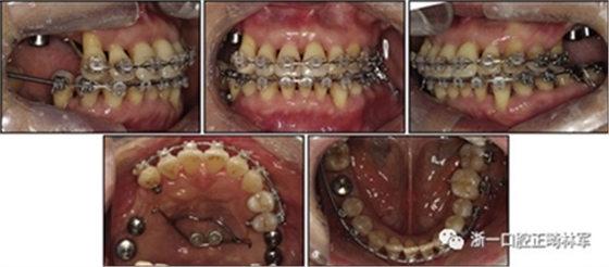 文獻優(yōu)秀正畸病例賞析--多顆牙齒缺失的牙周炎患者的跨學(xué)科綜合治療