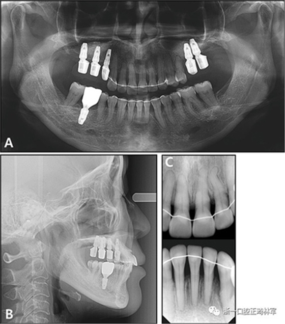 文獻優(yōu)秀正畸病例賞析--多顆牙齒缺失的牙周炎患者的跨學(xué)科綜合治療
