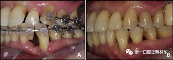 文獻優(yōu)秀正畸病例賞析--多顆牙齒缺失的牙周炎患者的跨學(xué)科綜合治療