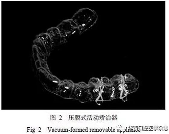 利用壓膜式活動矯治器壓入下頜第一、第二磨牙1例