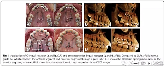 正畸文獻(xiàn)閱讀--用舌側(cè)滑動(dòng)牽引系統(tǒng)控制前牙區(qū)段：初步的CBCT研究