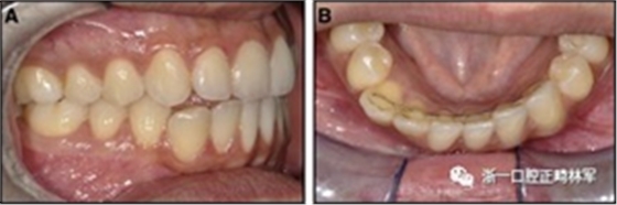 正畸文獻閱讀--固定舌側保持器作用下意外的牙齒移動