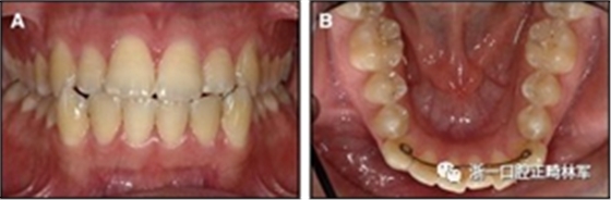 正畸文獻閱讀--固定舌側保持器作用下意外的牙齒移動