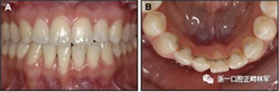 正畸文獻閱讀--固定舌側保持器作用下意外的牙齒移動