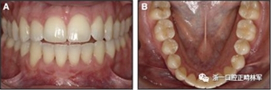 正畸文獻閱讀--固定舌側保持器作用下意外的牙齒移動