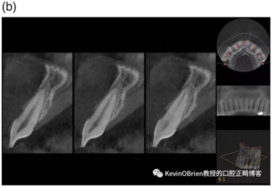 【同步新文】正畸牙根吸收是個(gè)問題嗎？一項(xiàng)新的系統(tǒng)評價(jià)