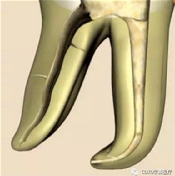 知識分享：根管治療的標(biāo)準(zhǔn)步驟