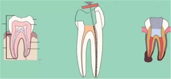知識分享：根管治療的標(biāo)準(zhǔn)步驟