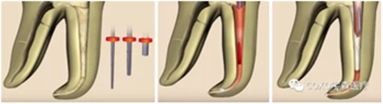 知識分享：根管治療的標(biāo)準(zhǔn)步驟