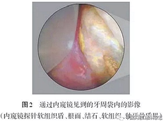 專題筆談 | 內窺鏡在牙周診療中的應用進展