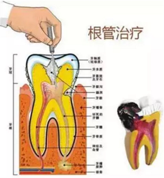 醫(yī)生，牙齒折斷不是應(yīng)該補上去嗎，為啥要做根管治療？