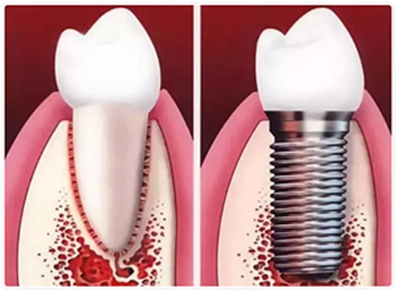 種植牙常見(jiàn)問(wèn)答你知道多少？