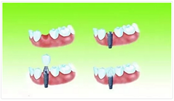 種植牙常見(jiàn)問(wèn)答你知道多少？