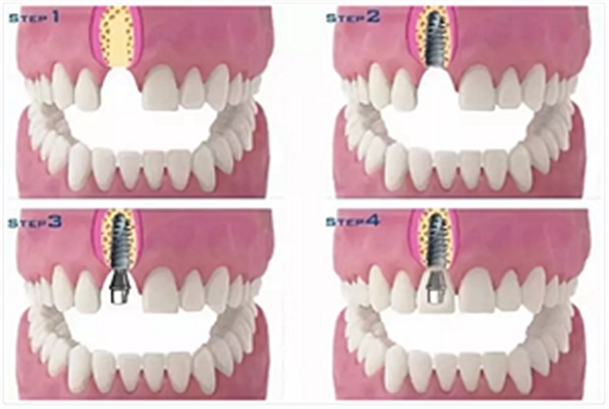 種植牙常見(jiàn)問(wèn)答你知道多少？