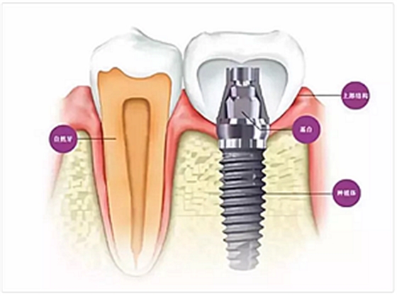 種植牙常見(jiàn)問(wèn)答你知道多少？