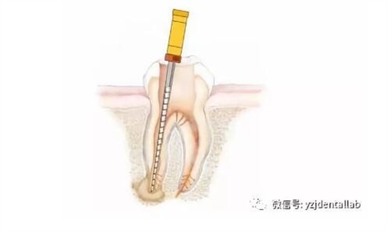 根管治療