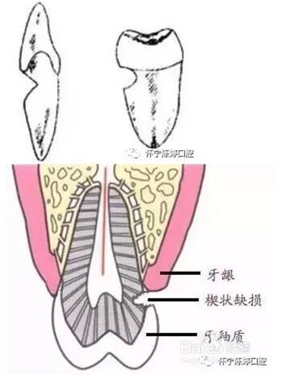 什么是牙齒楔缺？