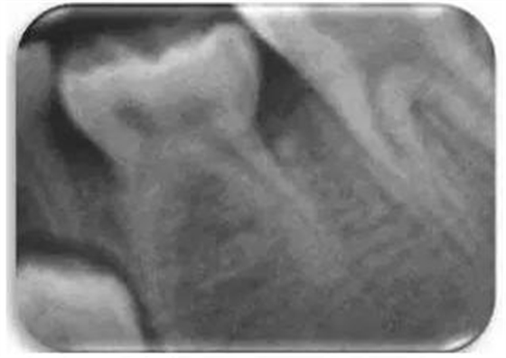 文獻(xiàn)直達(dá)｜一項(xiàng)西班牙的研究：低位乳磨牙的發(fā)生頻率、程度、牙根吸收和前磨牙發(fā)育不全情況