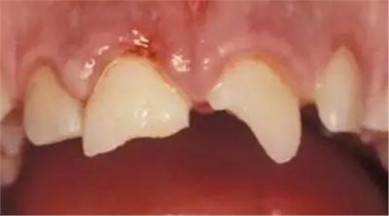 臨床實(shí)踐｜乳牙外傷處理指引（值得兒牙醫(yī)生收藏）