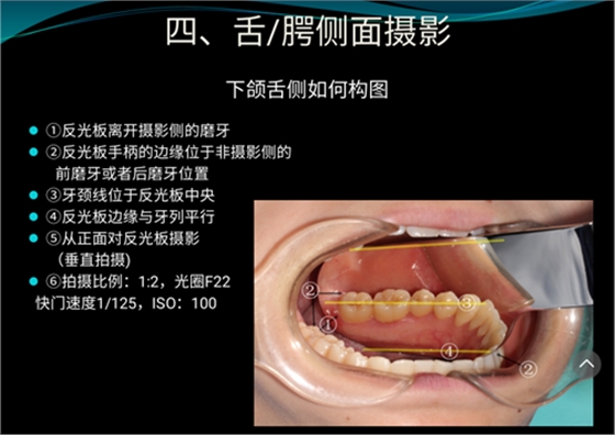 口內(nèi)照攝影方法與技巧分享