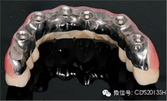 【經(jīng)驗(yàn)分享】無牙頜種植修復(fù)固位的并發(fā)癥與處理——宋應(yīng)亮教授