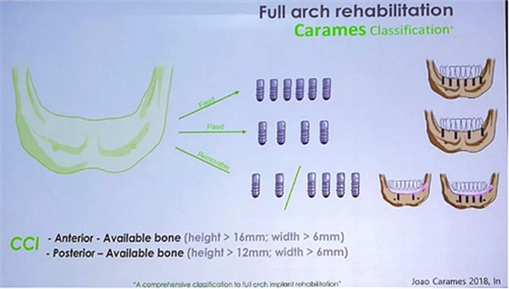 【熱點(diǎn)回顧】帶您深度了解無牙頜種植修復(fù)——Pro Arch