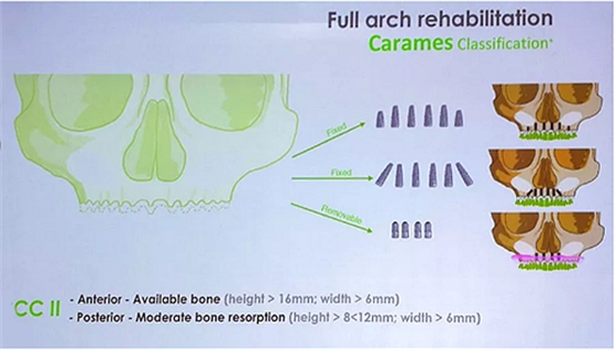 【熱點(diǎn)回顧】帶您深度了解無牙頜種植修復(fù)——Pro Arch