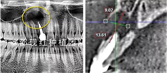 「科普篇」你真的了解它嗎？——β-磷酸三鈣