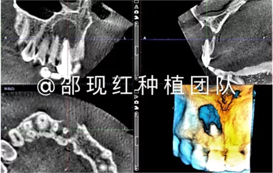 「科普篇」你真的了解它嗎？——β-磷酸三鈣