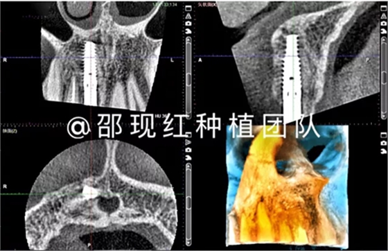 「科普篇」你真的了解它嗎？——β-磷酸三鈣