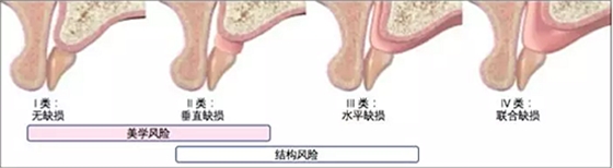 【文獻(xiàn)精讀】唇-齒-牙槽嵴分類：無牙頜上頜牙弓指南。診斷，風(fēng)險評估及種植治療指征