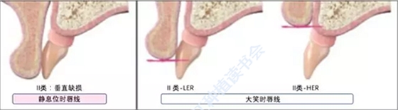 【文獻(xiàn)精讀】唇-齒-牙槽嵴分類：無牙頜上頜牙弓指南。診斷，風(fēng)險評估及種植治療指征