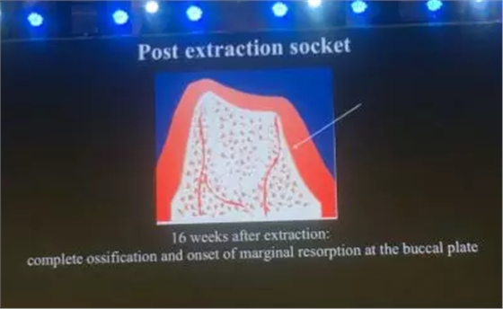 【聽課筆記】拔牙后位點(diǎn)的軟硬組織處理