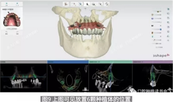 病例報道│全程數(shù)字化輔助無牙頜種植即刻負(fù)重