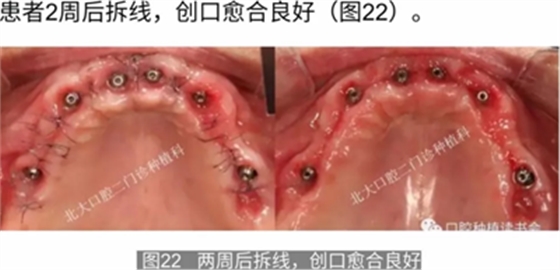 病例報道│全程數(shù)字化輔助無牙頜種植即刻負(fù)重