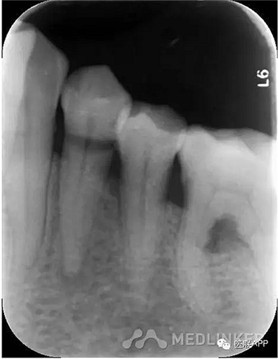楔狀缺損導(dǎo)致根尖周炎