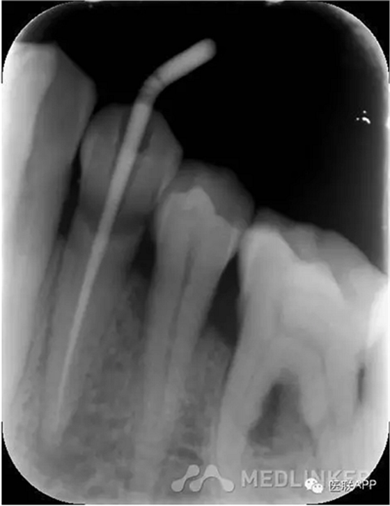 楔狀缺損導(dǎo)致根尖周炎